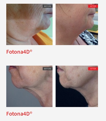 necklift jawline tightening jowl treatment non surgical laser fotana facelift