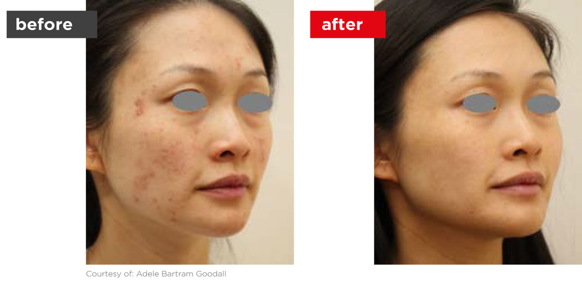 Acne-Before_Afters-1