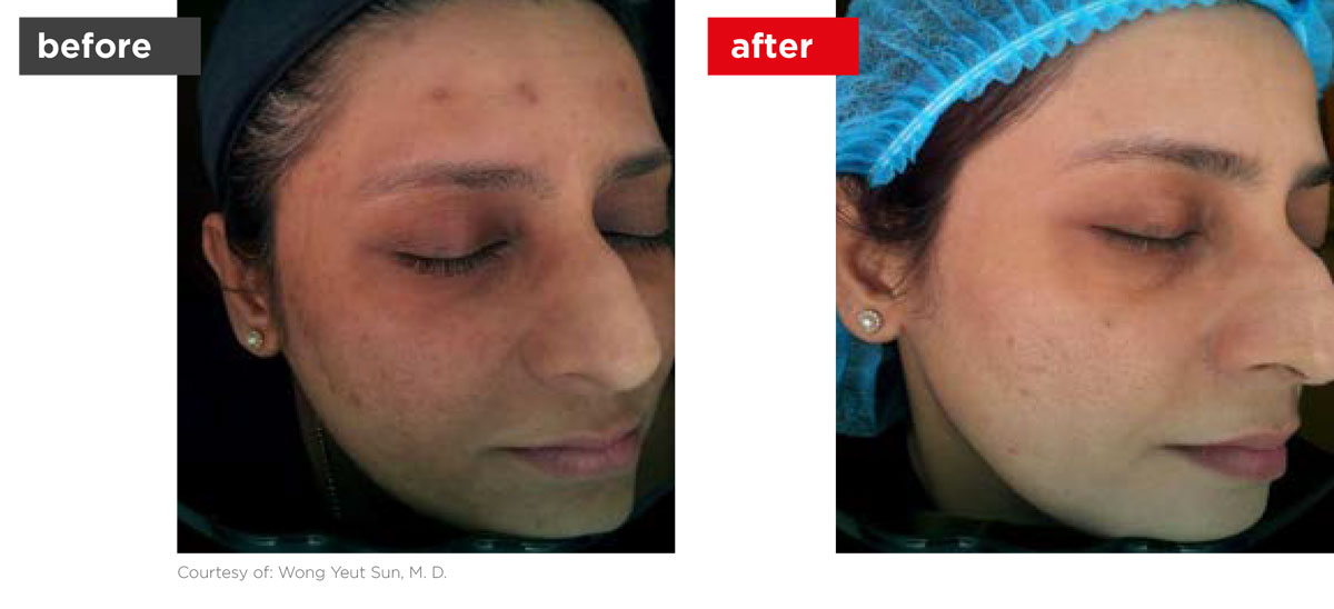 Acne-Before_Afters-10