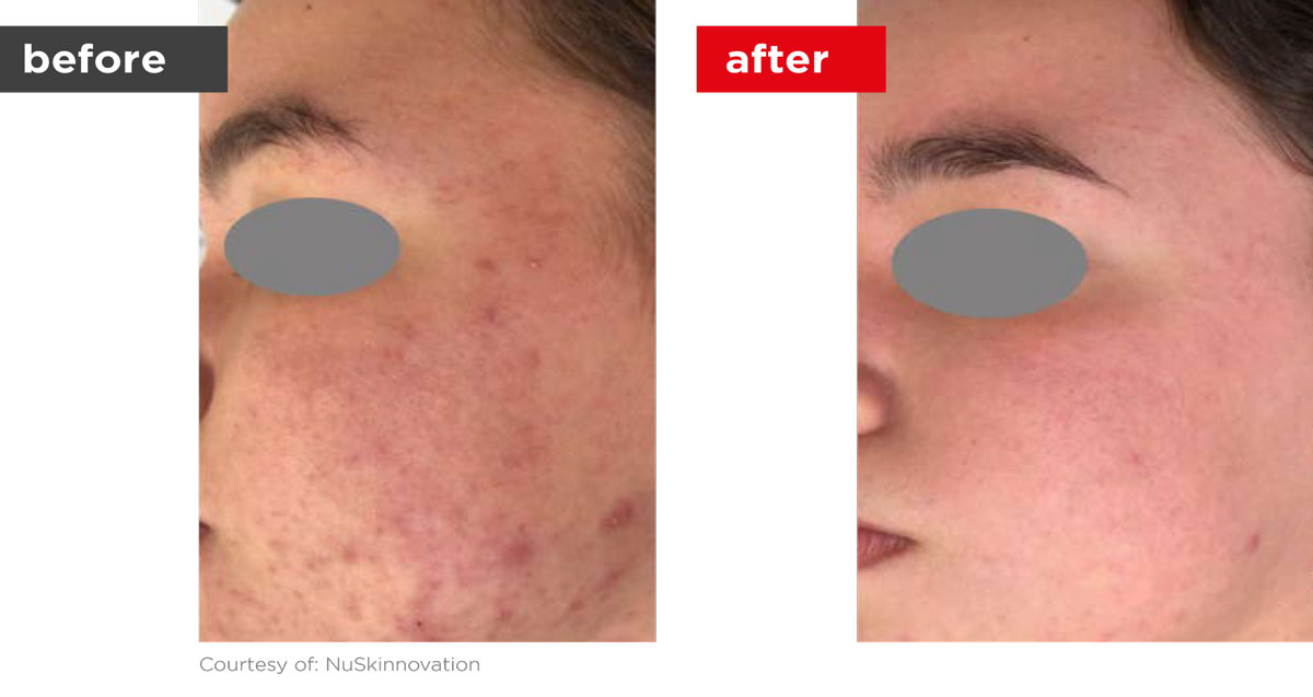 Acne-Before_Afters-11