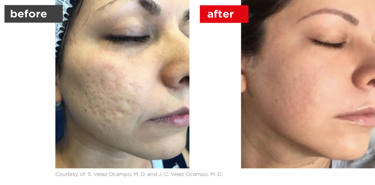 Acne-Before_Afters-2