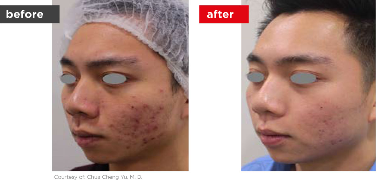 Acne-Before_Afters-4
