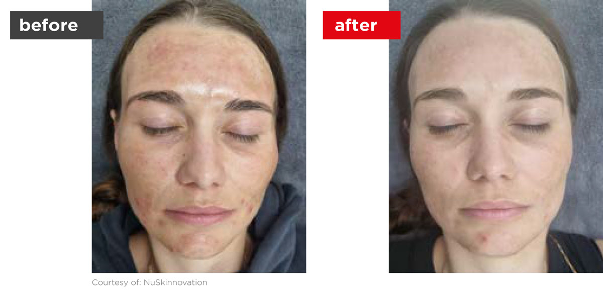 Acne-Before_Afters-5