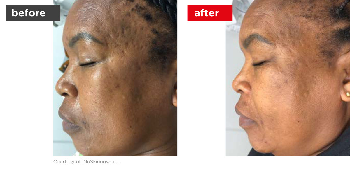 Acne-Before_Afters-6