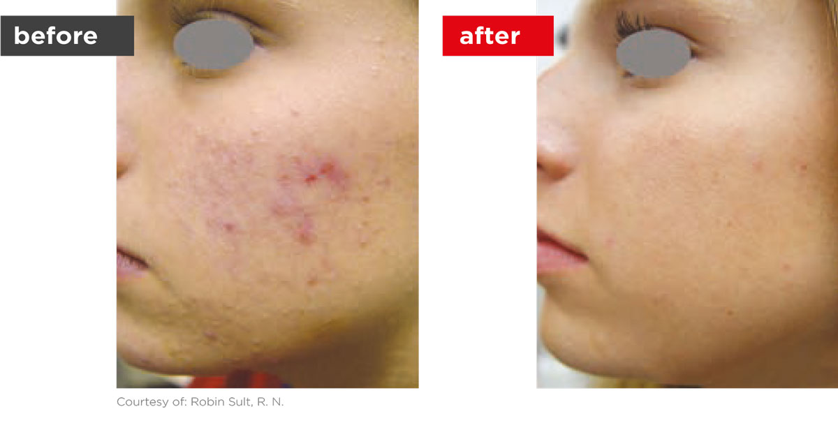 Acne-Before_Afters-7