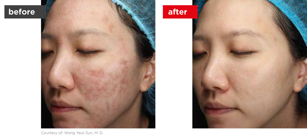 Acne-Before_Afters-9