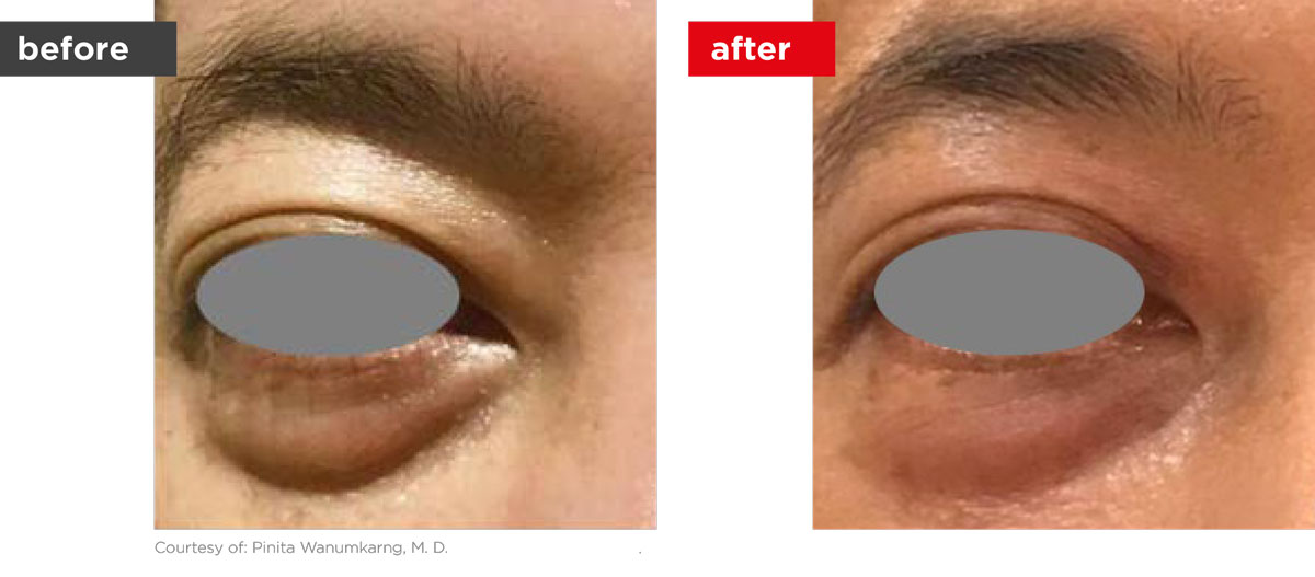 SmoothEye-Before_After-3